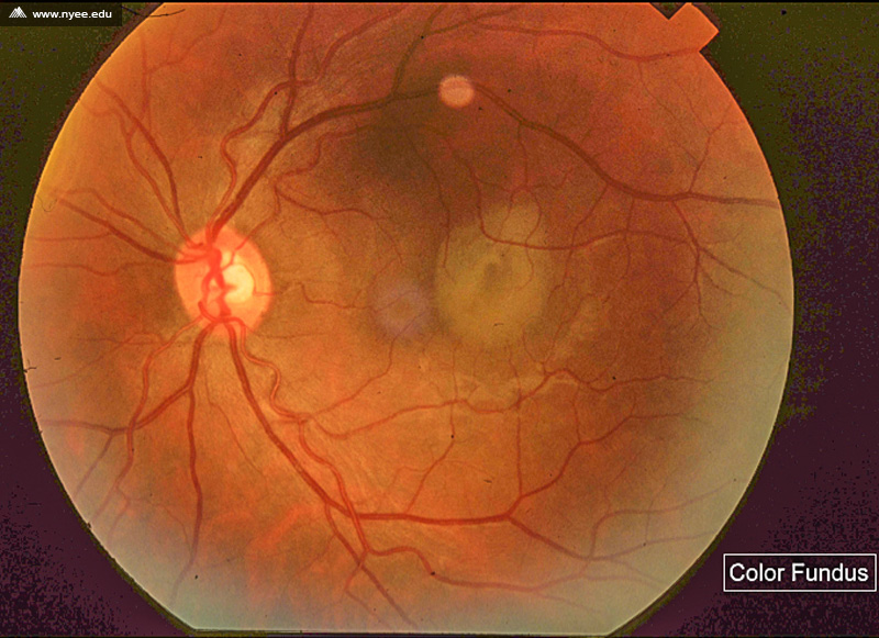 CSR Central Serous Retinopathy Chronic (1 of 10) NYEE